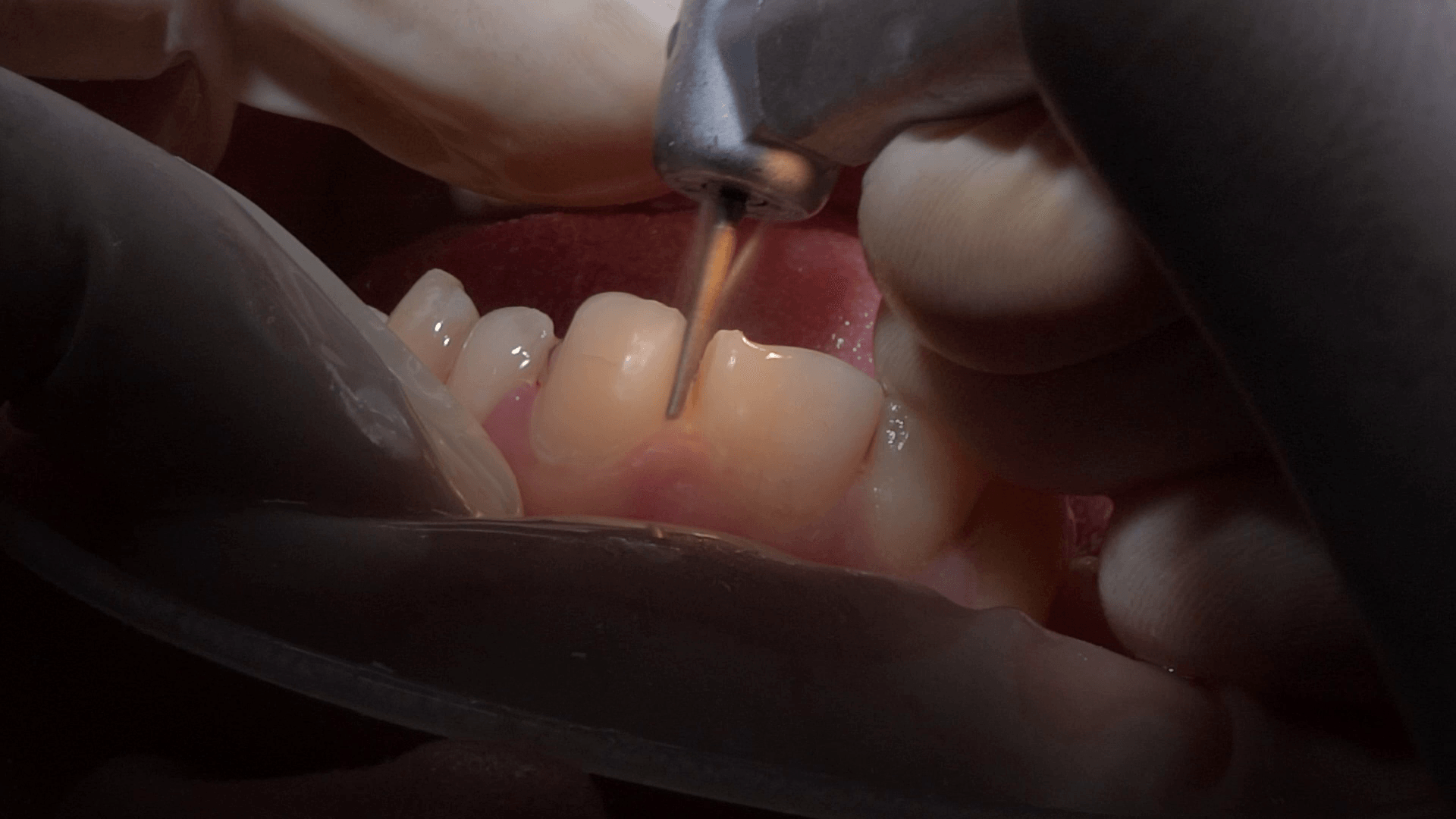 Treatment In One Visit